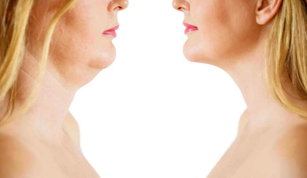 Double Chin treatment Greater London (Kensington and Chelsea) before and after results