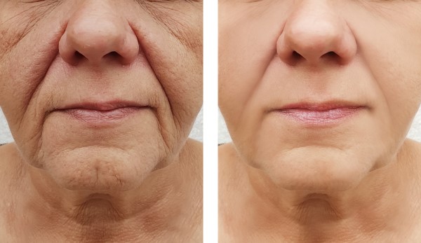 Learn more about Morpheus8 Treatment Greater London (Kensington and Chelsea) today!