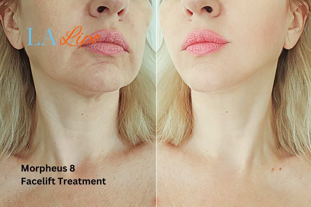 Turn back time with Morpheus8 Treatment Greater London (Kensington and Chelsea)
