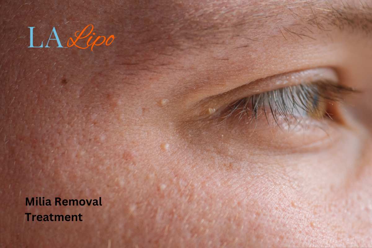 Cryopen Milia Removal: Is It the Easiest and Safest Option Greater London (Kensington and Chelsea)?