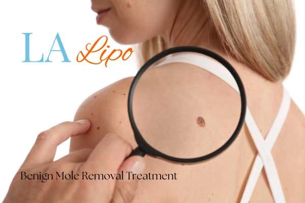 Woman having her inspection of blemish before mole removal Greater London (Kensington and Chelsea)