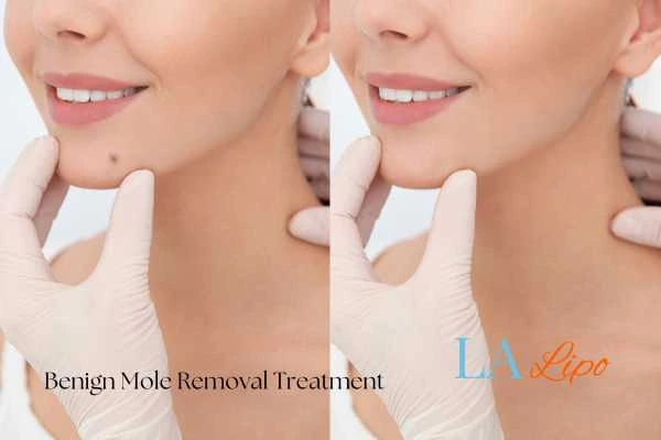 Before and after mole removal Greater London (Kensington and Chelsea) treatment