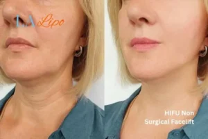 hi-fu for wrinkles Greater London (Kensington and Chelsea) before and after results