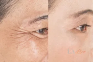 Before and after results of woman - HI-fu wrinkles reduction treatment Greater London (Kensington and Chelsea)