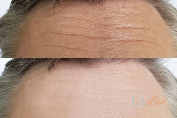 results of HIFU Greater London (Kensington and Chelsea) on mans forehead to help reduce lines and wrinkles