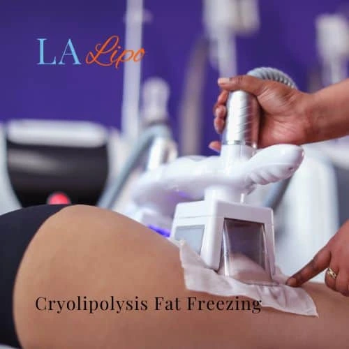 fat freezing - Cryolipolysis Greater London (Kensington and Chelsea)