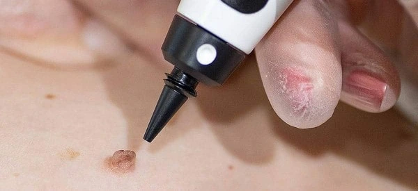 skin tag removal using cryopen Greater London (Kensington and Chelsea)