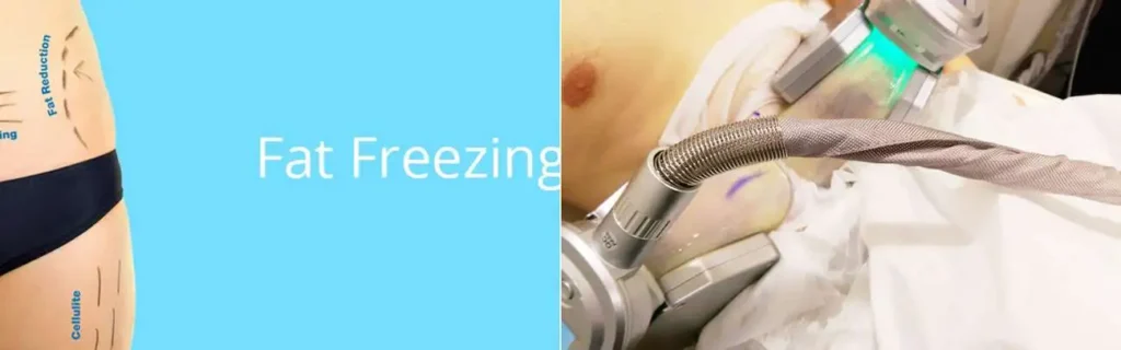 multi areas of a persons body having coolsculpting Greater London (Kensington and Chelsea) treatment
