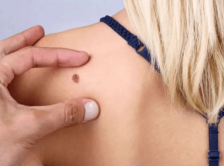 woman having mole removal Greater London (Kensington and Chelsea) consultation before treatment.