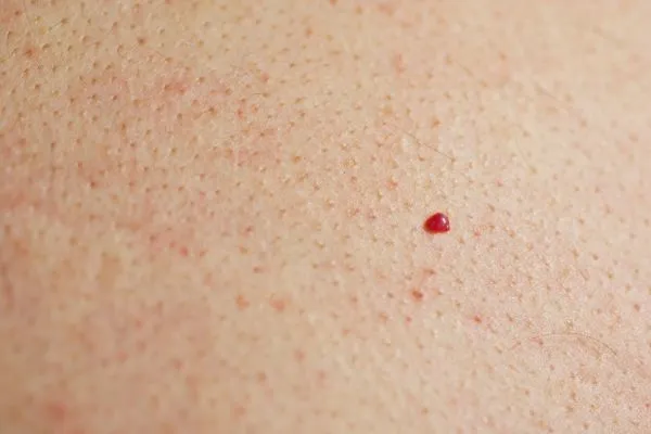 close up of a cherry angioma Greater London (Kensington and Chelsea)