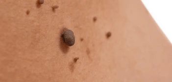 image of a skin tag Greater London (Kensington and Chelsea)