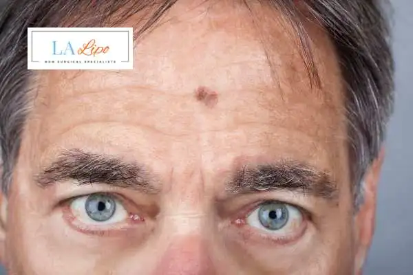 Solar Lentigo Removal Greater London (Kensington and Chelsea) image of man with mark on his forehead