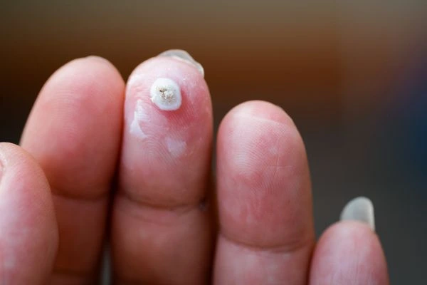 wart on person finger - cryotherapy to treat from LA LIPO Greater London (Kensington and Chelsea)