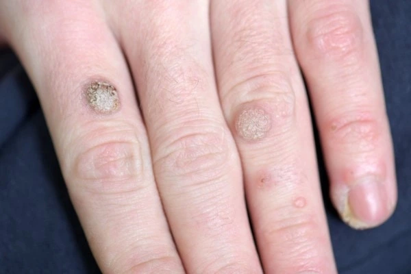 photo of warts on person hand - see wart removal Greater London (Kensington and Chelsea) from LA LIPO