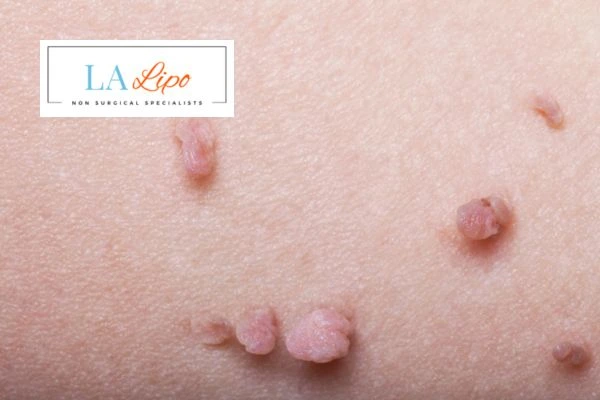 Does cryopen skin tag removal Greater London (Kensington and Chelsea) hurt? Find out now call our team today!