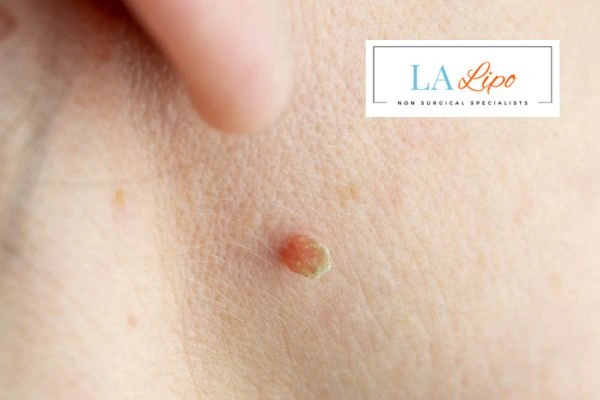 Book skin tag removal Greater London (Kensington and Chelsea) today speak to our team now!