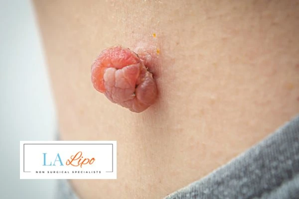 Interested in skin tag removal Greater London (Kensington and Chelsea)? Concerned about the pain? Find out more today!