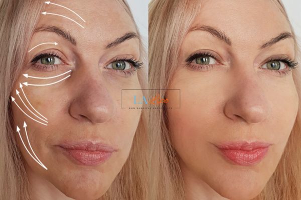 Morpheus 8 results Greater London (Kensington and Chelsea) face lift.