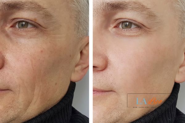 See the amazing results of Morpheus8 Treatment Greater London (Kensington and Chelsea)!