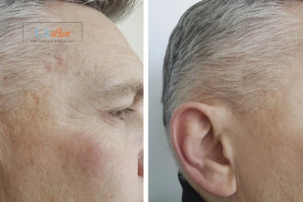 Mens Before & After Morpheus 8 Results Greater London (Kensington and Chelsea)