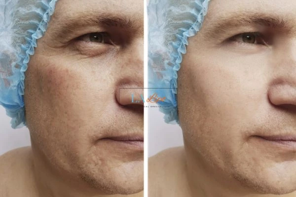Before and after Morpheus 8 Results Greater London (Kensington and Chelsea)