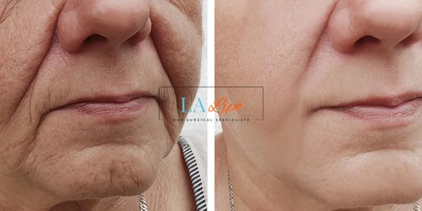 Older lady deeper wrinkle reduction - LA LIPO Morpheus 8 Results Greater London (Kensington and Chelsea)