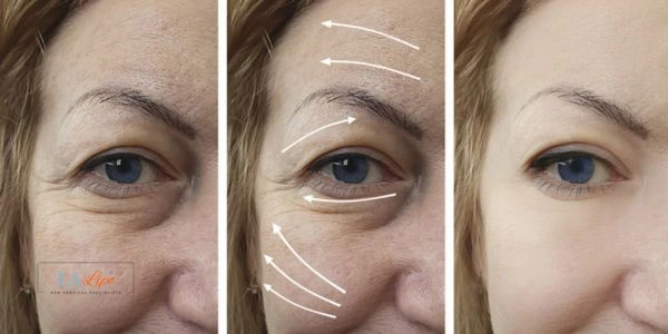 Amazing eye lift Morpheus 8 results Greater London (Kensington and Chelsea)
