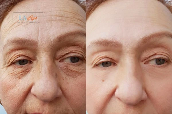 The powerful benefits of Morpheus8 Treatment Greater London (Kensington and Chelsea) - Call Our team today!