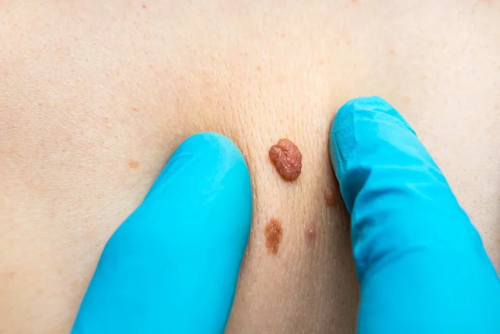 LA LIPO Cryopen Lesion Removal Prices Greater London (Kensington and Chelsea)