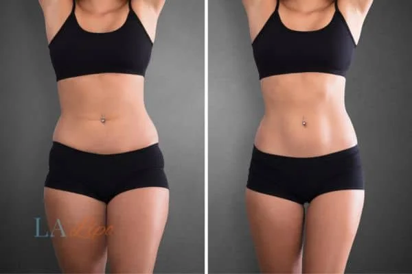 before and after results of non-surgical treatment to help a woman's body image and mental health Greater London (Kensington and Chelsea)