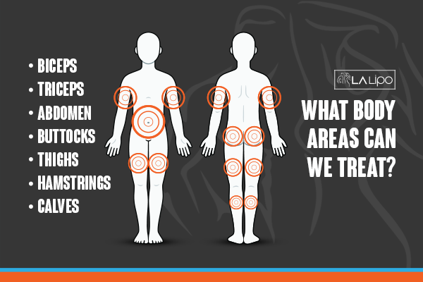 Diagram to show areas you can have LA-EMS Body Sculpting Treatment Greater London (Kensington and Chelsea)
