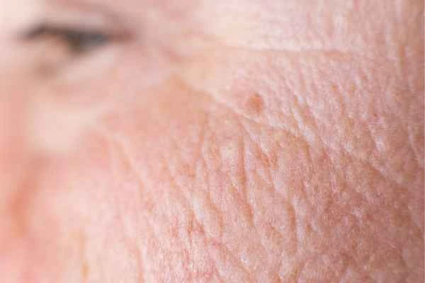 close up picture of a woman's face showing an age spot Greater London (Kensington and Chelsea)