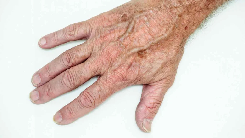 Male hand showing age spot Greater London (Kensington and Chelsea)