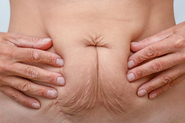 Image of a woman's stomach with loose skin - example of skin tightening Greater London (Kensington and Chelsea) options