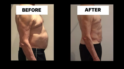 What Symptoms Can Diastasis Recti Cause in Men? Weak Core, Back Pain and Poor Posture Greater London (Kensington and Chelsea)